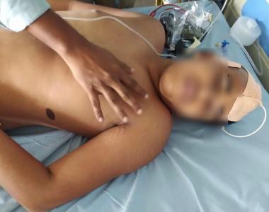 Brain Surgery for Rashid